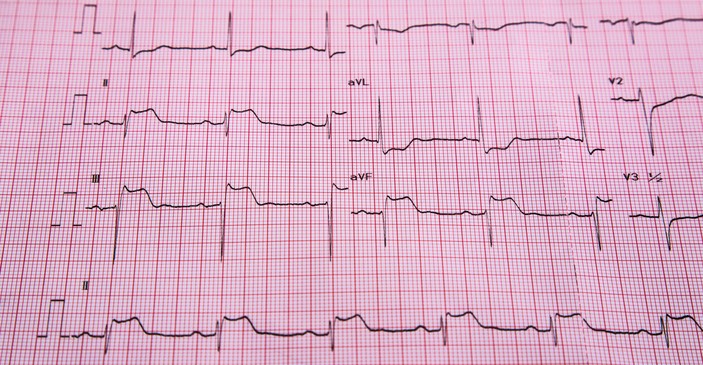 EKG - STEMI - ST-emelkedés és szívizominfarktus jelei