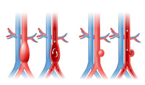 Aorta aneurizma és véráramlás