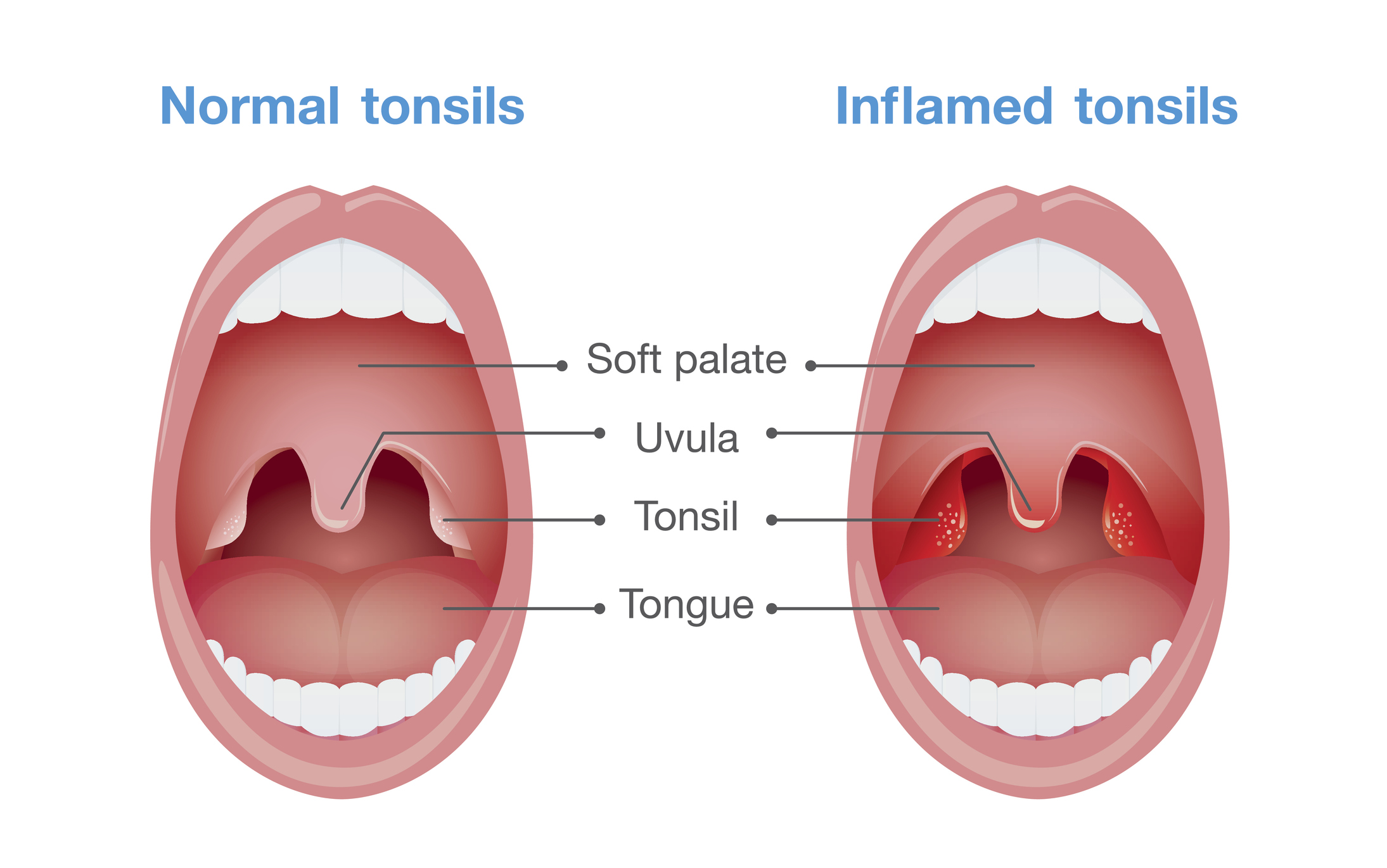 Angina - a mandulák gyulladása