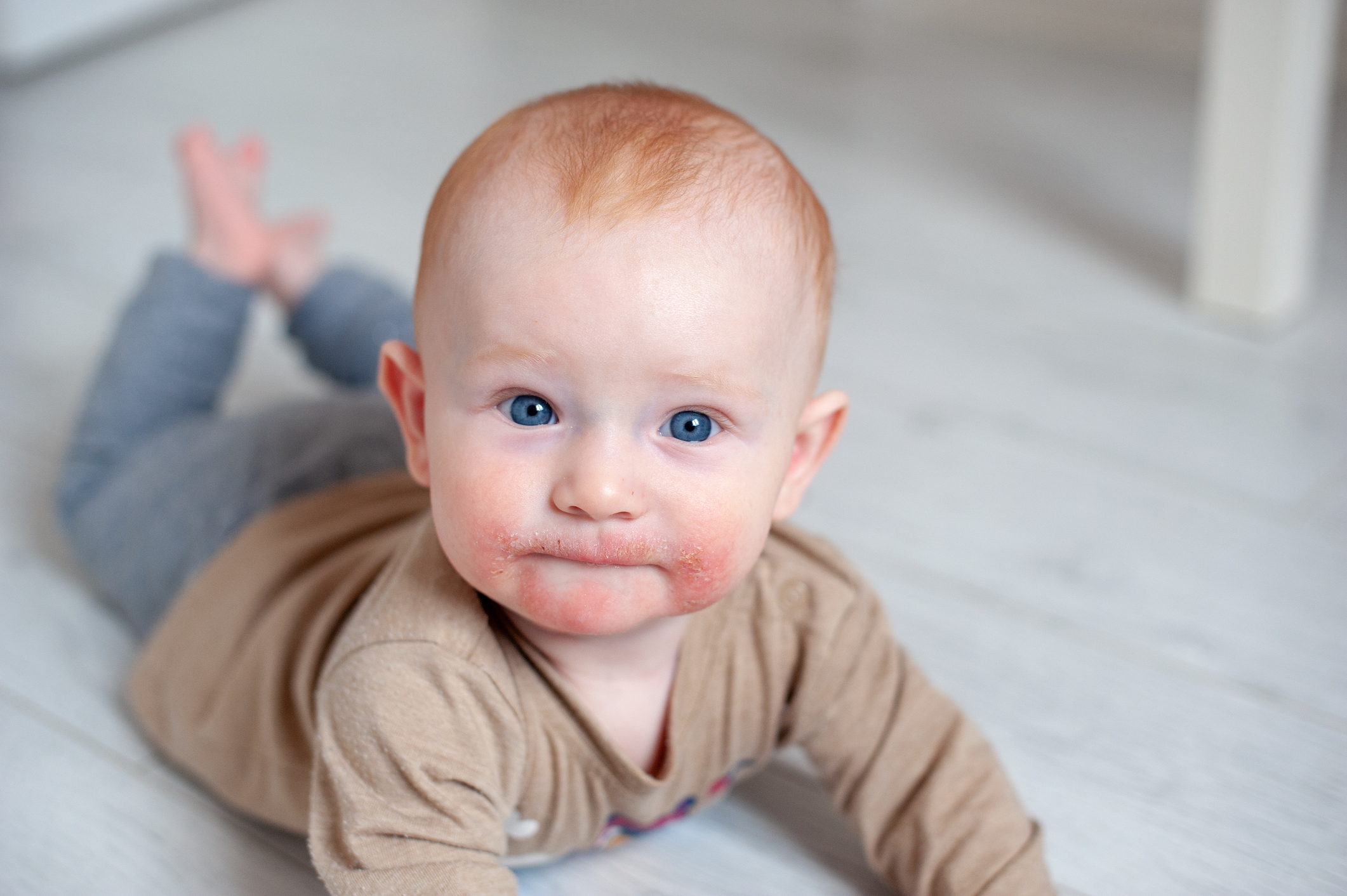 Atópiás dermatitis a gyermek arcán