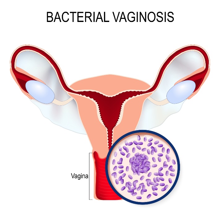 Bakteriális vaginózis és Gardnerella vaginalis túlszaporodás