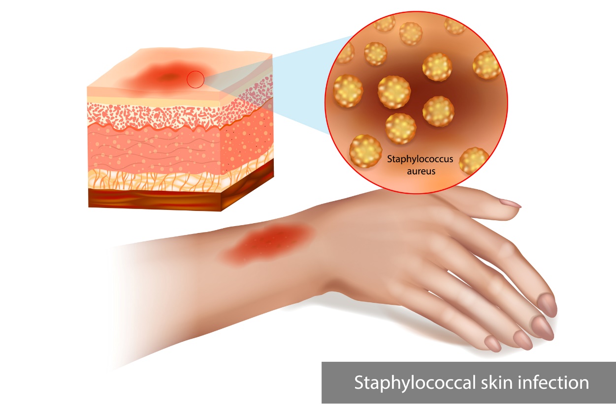 Staphylococcus bőrfertőzés