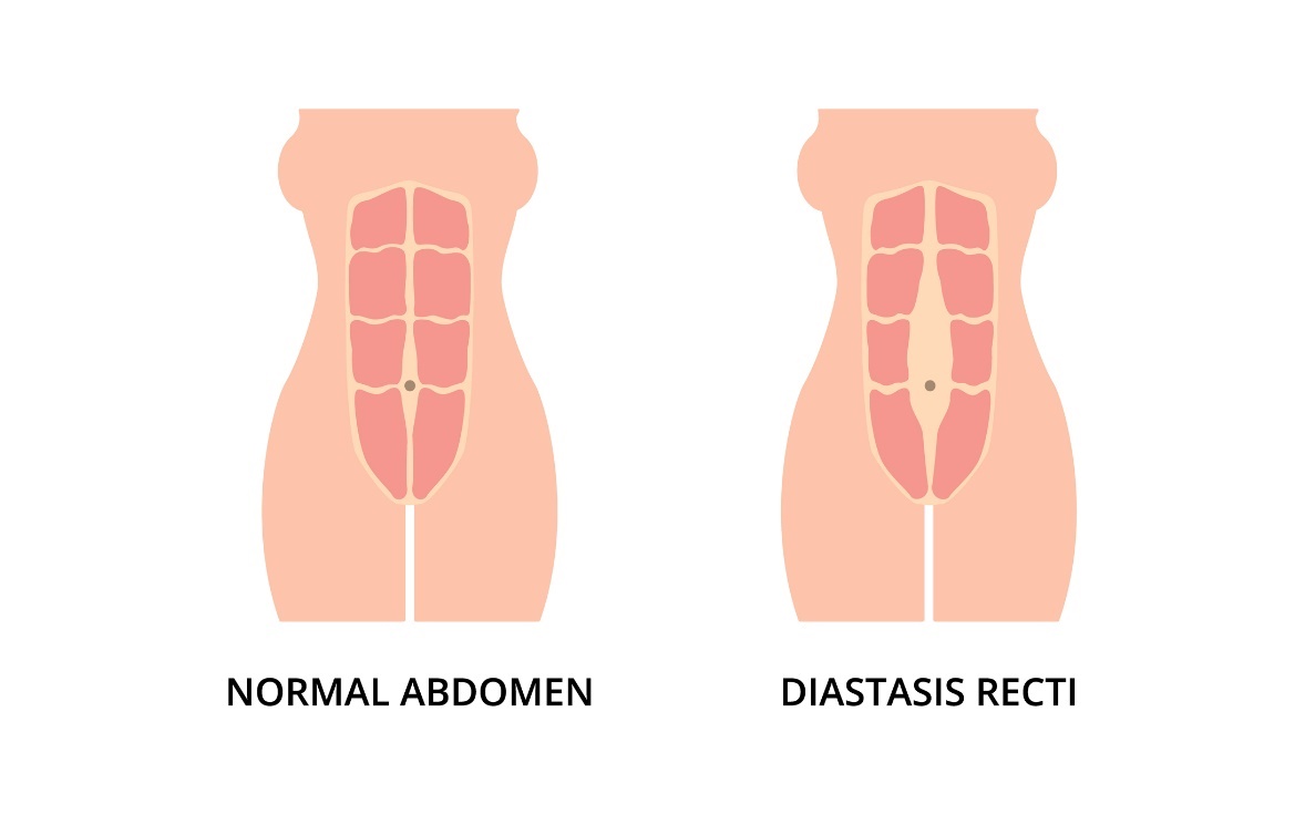 A hasizmok fiziológiai állapota és a bal és jobb oldali rectus abdominis izmok diasztázisa (távolsága) a linea alba középvonalától számítva