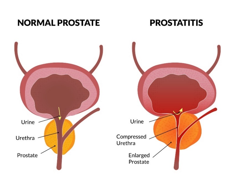 A prosztata és a prosztatagyulladás fiziológiai állapota