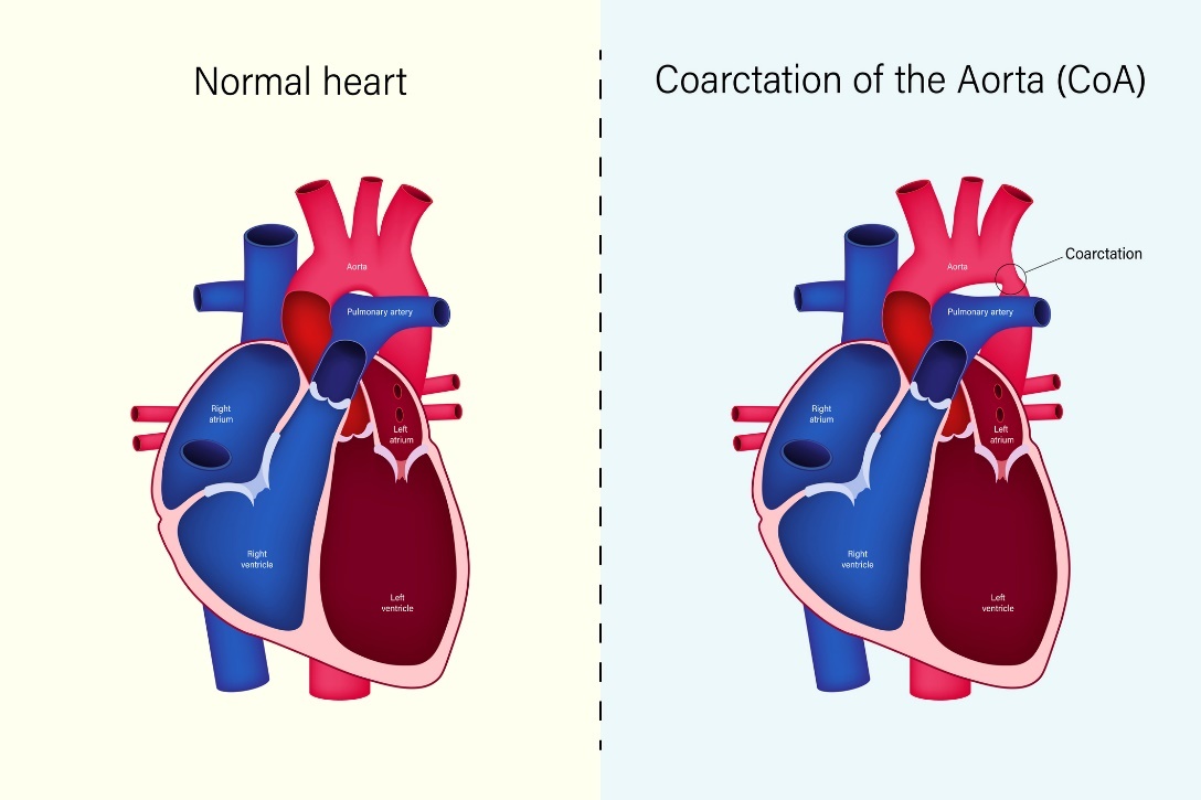 A szív élettani állapota és az aorta coarctatio (CoA)