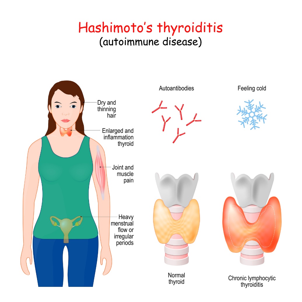 Hashimoto thyreoiditis és klinikai tünetek