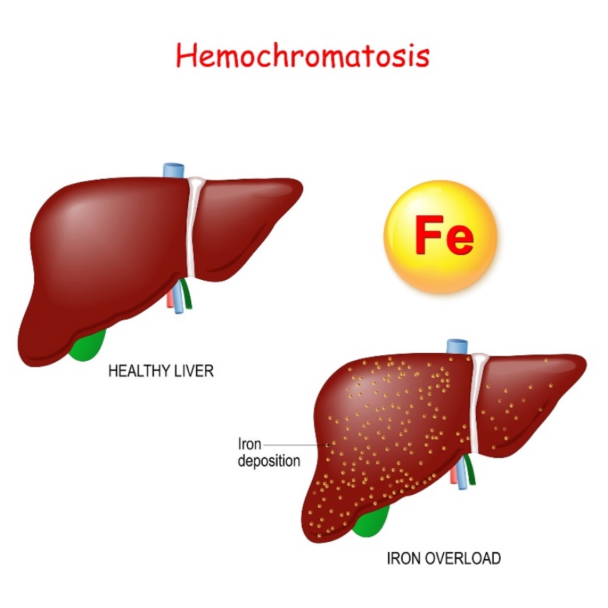 Haemochromatosis: a máj fiziológiája és patológiája túlzott vas (Fe) lerakódással