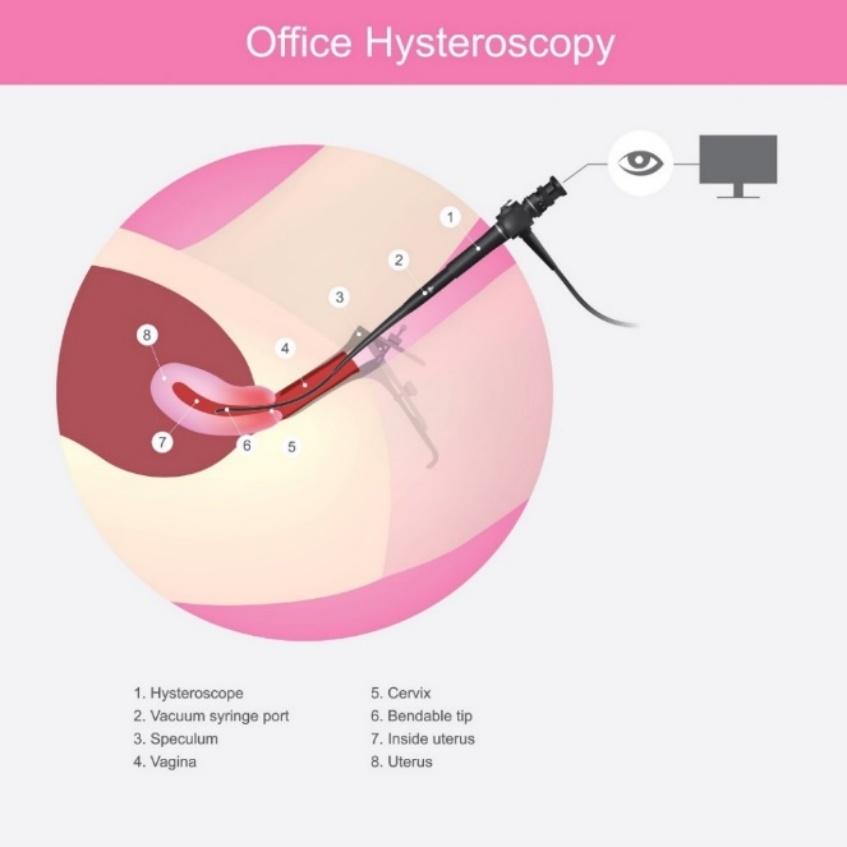 Hysteroscopia