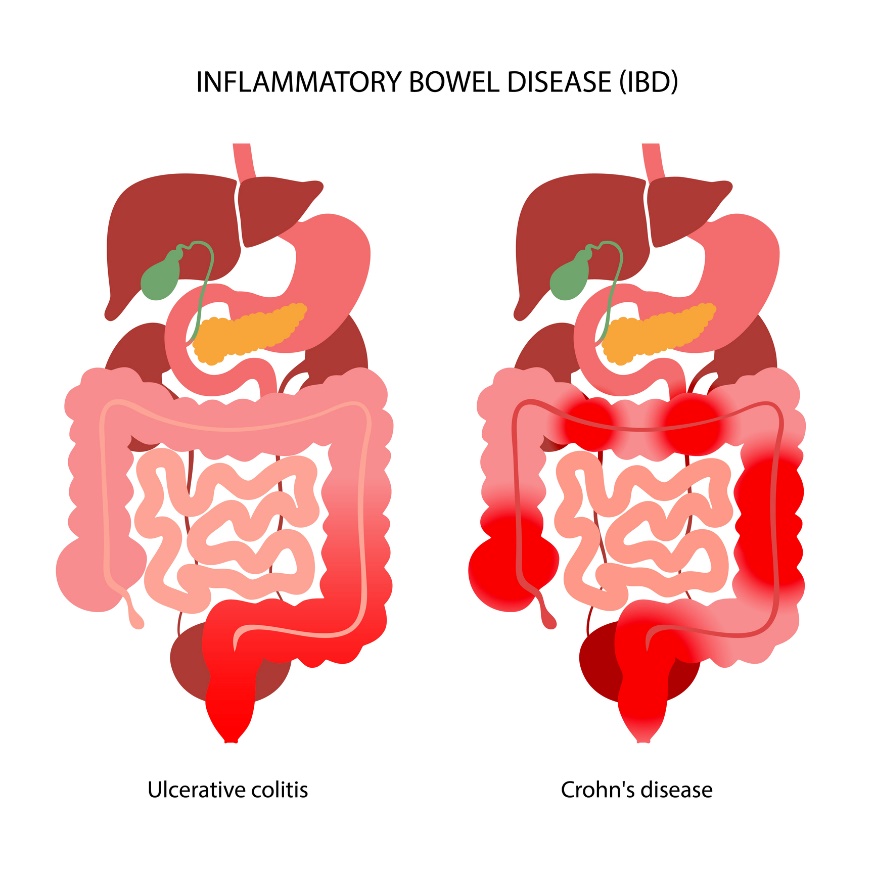 IBD: a gyulladásos reakció lokalizációja szerint fekélyes vastagbélgyulladásra és Crohn-betegségre osztva.