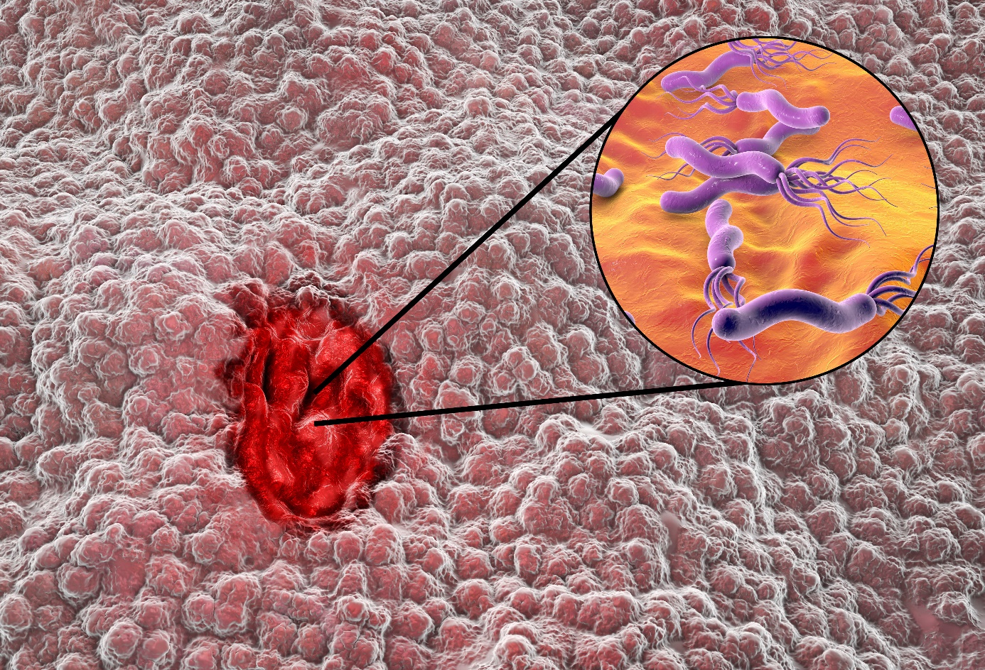 Helicobacter pylori fertőzés