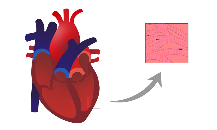 Myocarditis: a szívizom falában a szívizomsejtek infiltrációjával és degenerációjával járó gyulladásos folyamat.