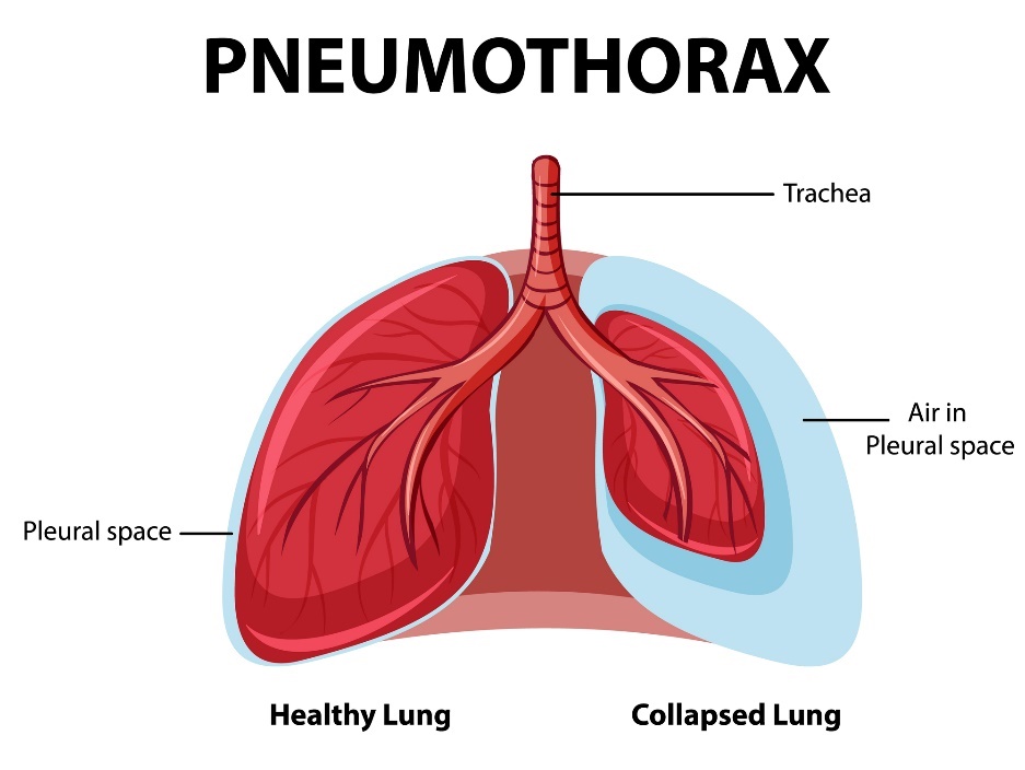 Pneumothorax: egészséges és összeomló tüdő