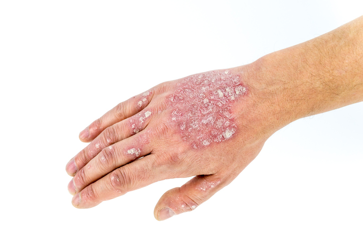 Psoriasis vagy pikkelysömör a kézen, a kéz hátán