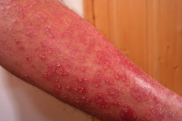 Psoriasis a felső végtagon, az alkaron