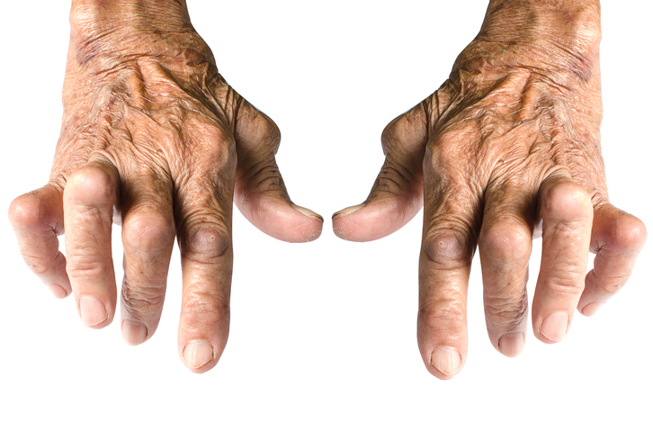 A rheumatoid arthritis későbbi formája