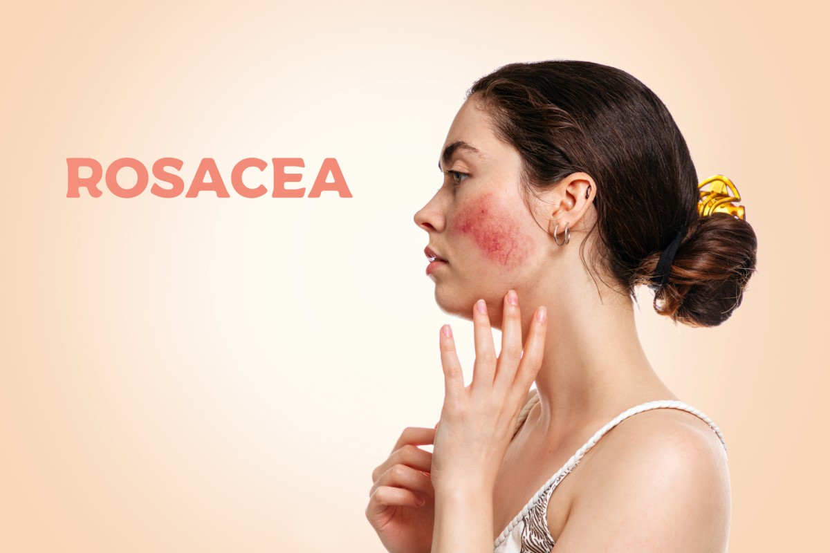 Nő oldalról, arc rosaceával - rosacea