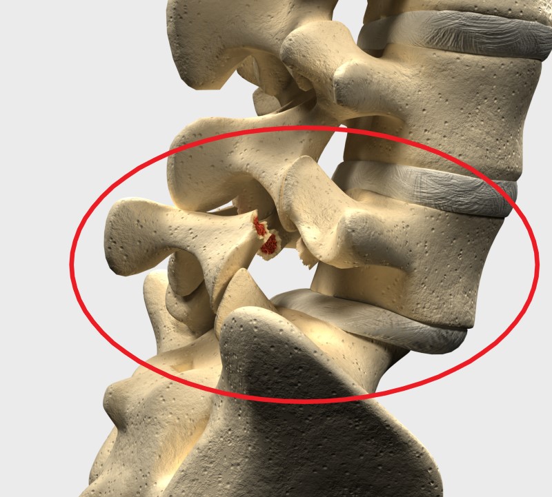 Spondylolisthesis az L5 és S1 ágyéki régióban - gerincvázmodell