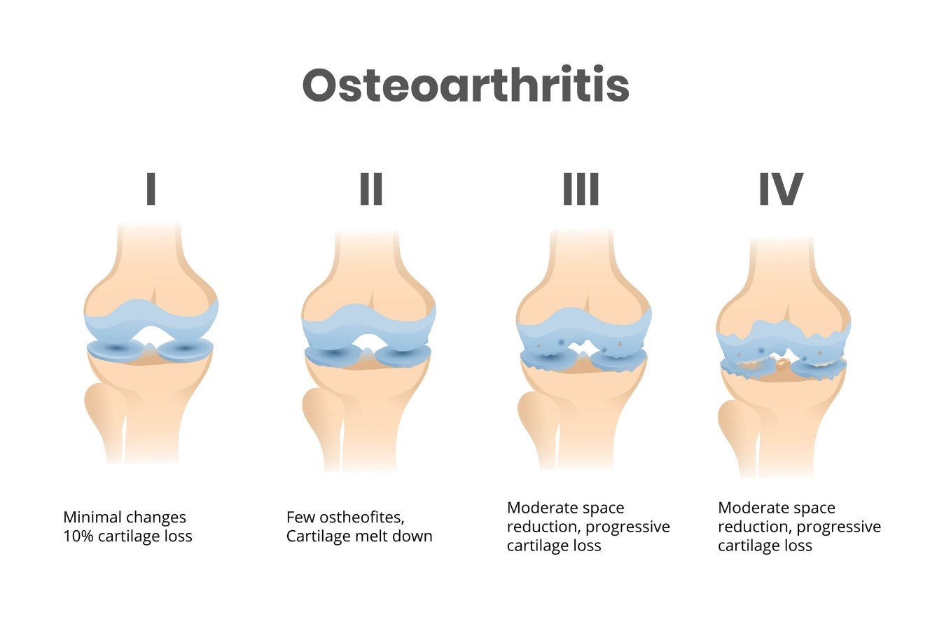 Az arthrosis 4 stádiuma