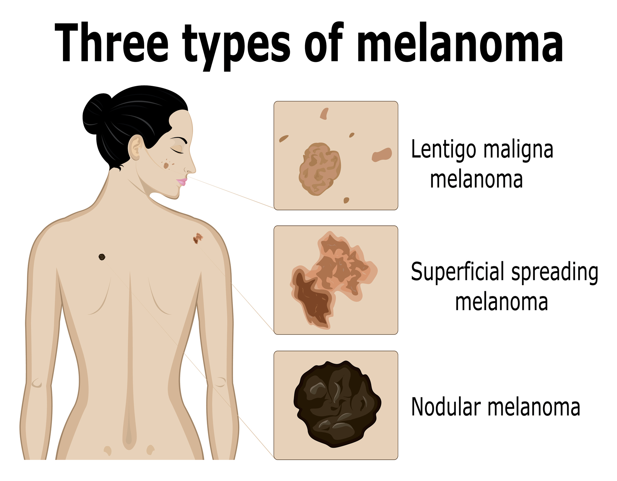 A melanoma három típusának képalkotása