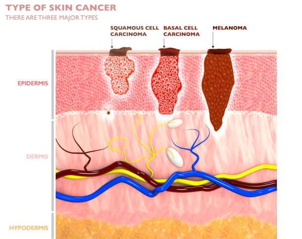 A bőrdaganatok típusai, behatolásuk a bőrbe - laphámrák, basalioma és melanoma