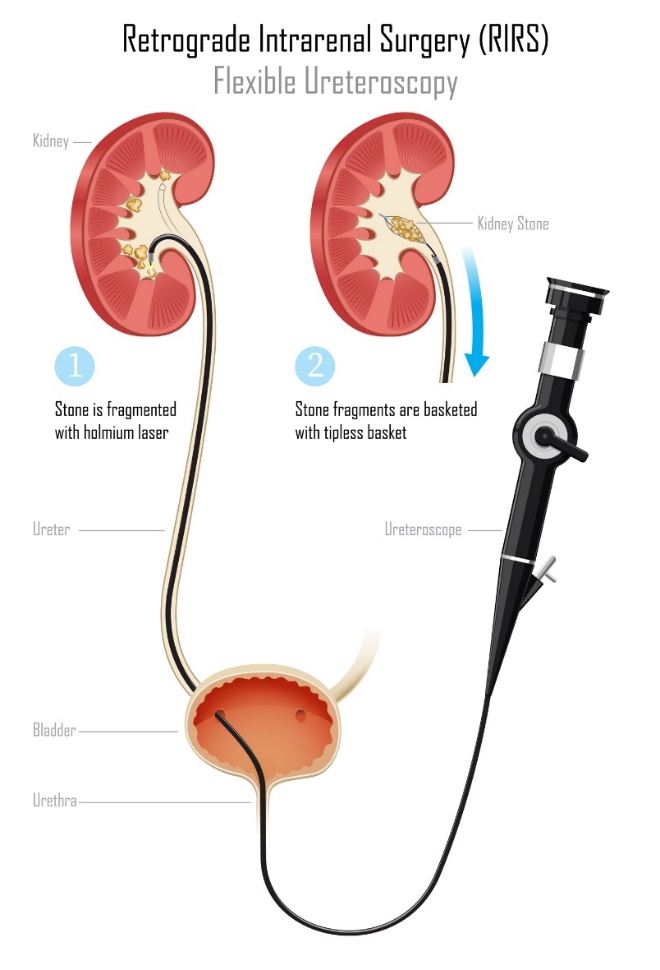 Ureteroszkópia