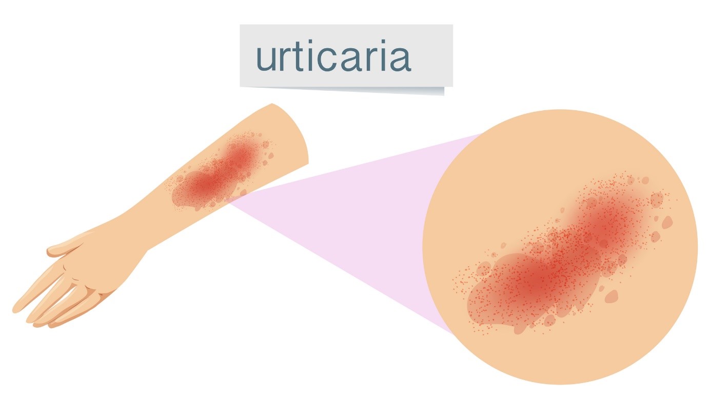 Urticaria, urticaria, urticaria, urticaria, urticaria, urticaria, urticaria