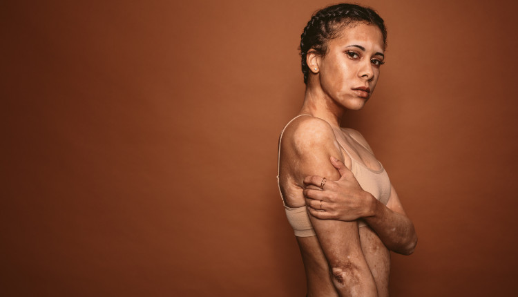 nő fehér foltokkal a testén - vitiligo