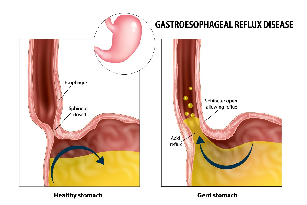 Gastrooesophagealis reflux: nyelőcső, záróizom, gyomor és gyomorsav.