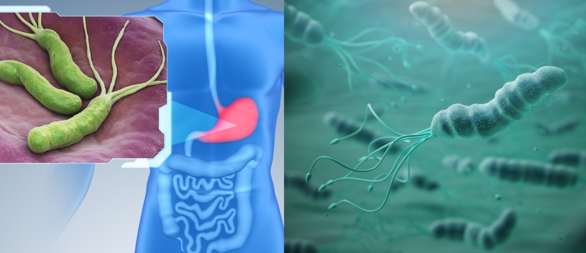 A Helicobacter pylori megtelepszik a gyomornyálkahártyán, és a gyomorhurut, a fekélybetegség és a rák kockázati tényezője.