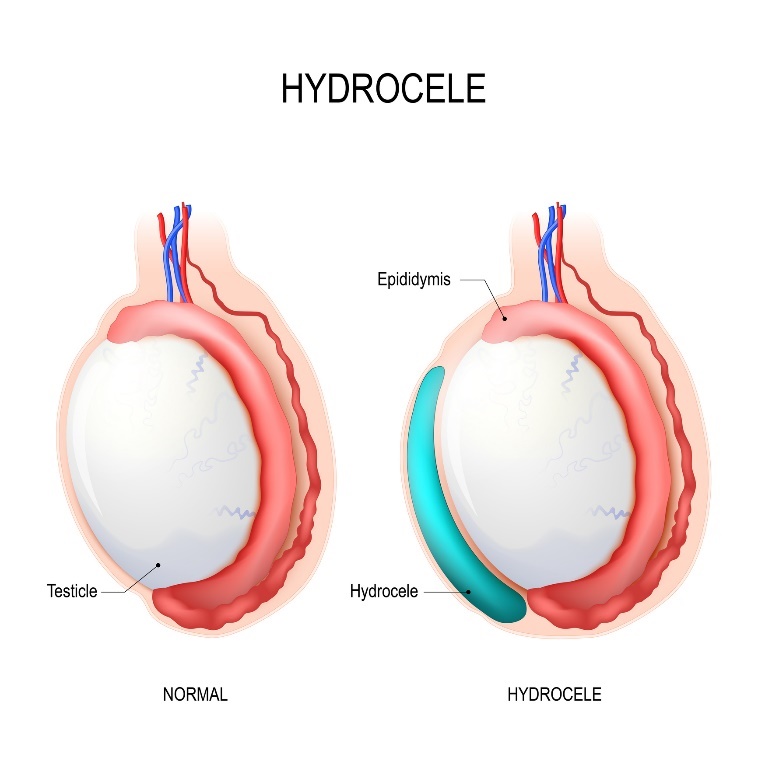 Hydrocele: Herék (here), mellékhere, Hydrocele (felgyülemlett folyadék)