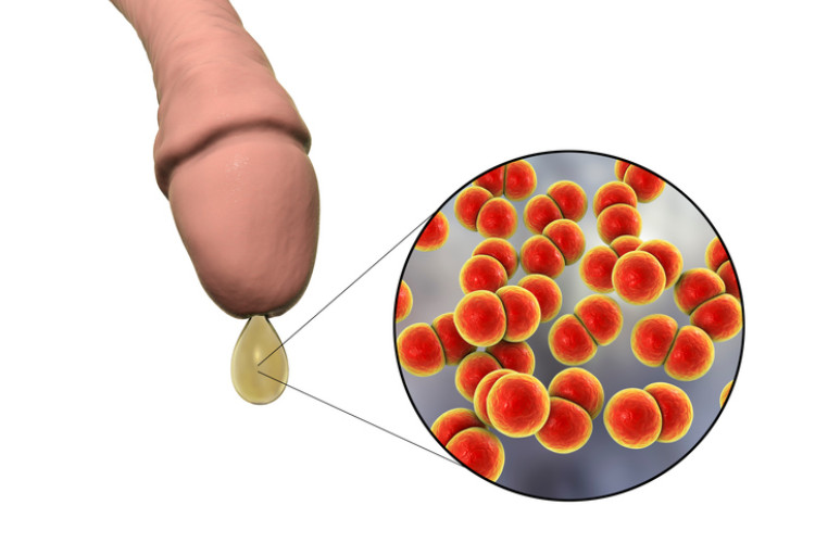 a pénisz achemája kisüléssel és mikroszkopikus gonorrhea baktériumokkal