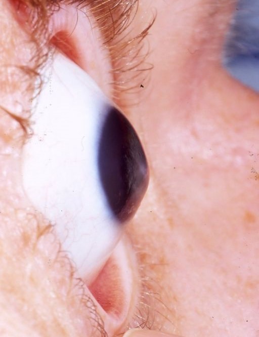 Keratoconus, a szaruhártya degenerációja