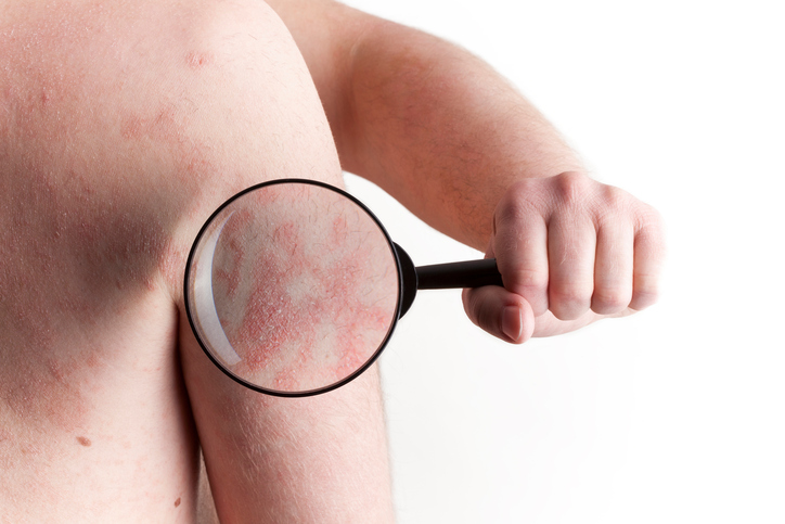 Psoriasis a vállon - nagyító alatt