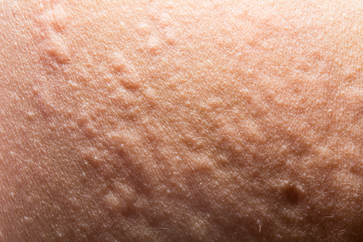 Urticaria, egyébként urticaria a bőrön is