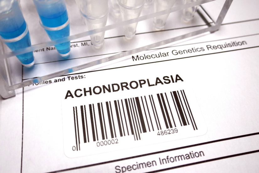 Achondroplasia: Mik a veleszületett csontrendellenesség okai, tünetei?