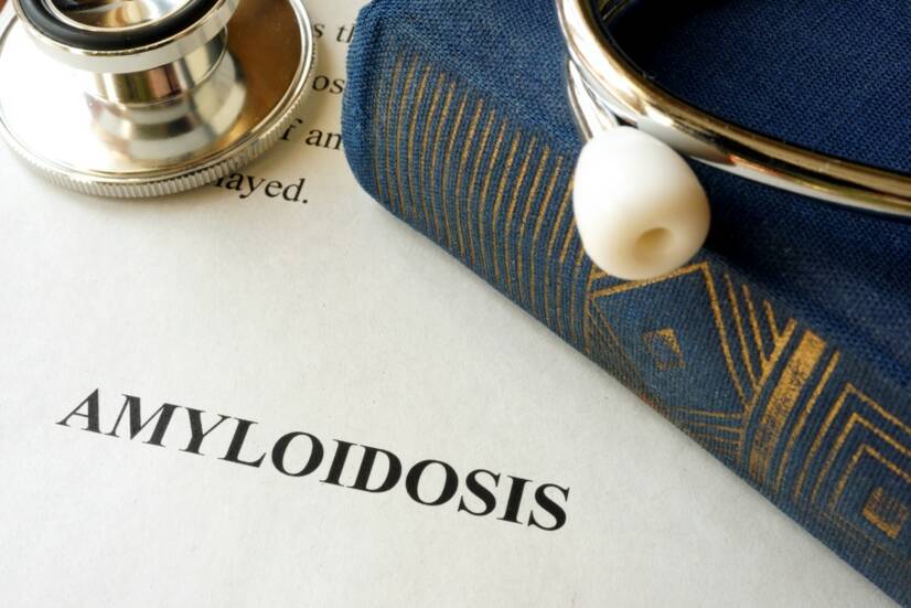 Amyloidosis: mi ez és miért alakul ki, milyen tünetei vannak?