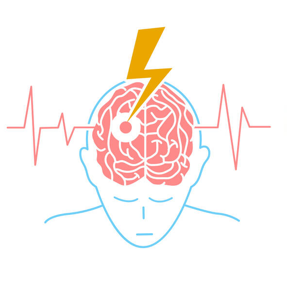 Mi az a stroke? Ismeri a tüneteket, a kockázatokat és a kezelést?