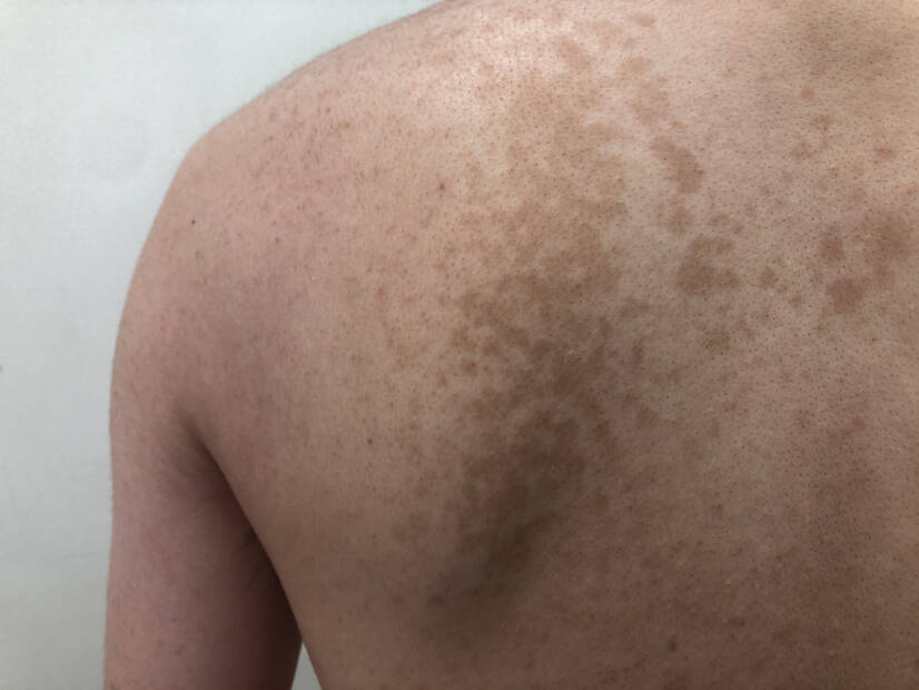 Pityriasis versicolor: Mi ez és milyen tünetei vannak? Okai és terjedése