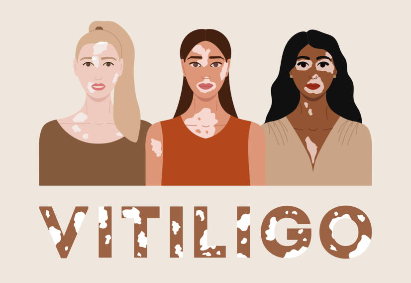 Vitiligo: Mi a vitiligo, mik az okai és tünetei, mikor kezdődik?