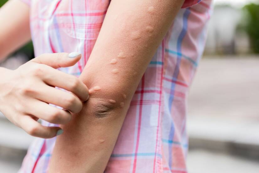 Urticaria: Urticaria nem csak csalánégés után? Betegséget jelent?