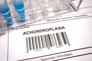 Achondroplasia: Mik a veleszületett csontrendellenesség okai, tünetei?