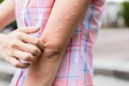 Urticaria: Urticaria nem csak csalánégés után? Betegséget jelent?